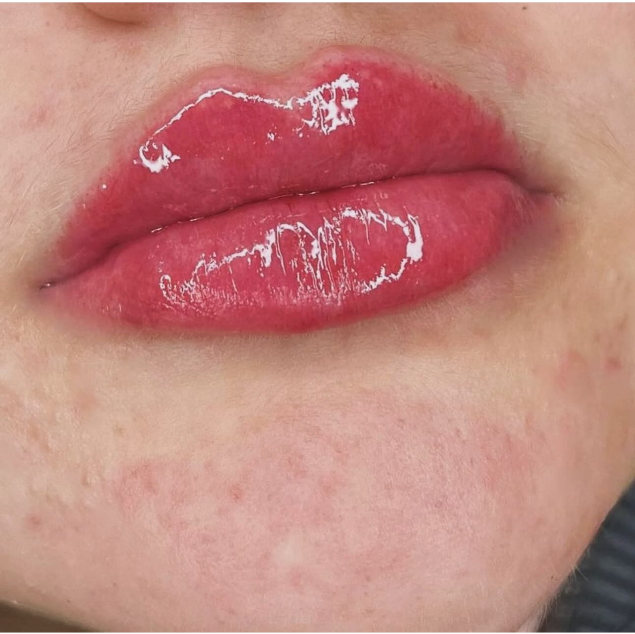 Lip Filler Enhancement