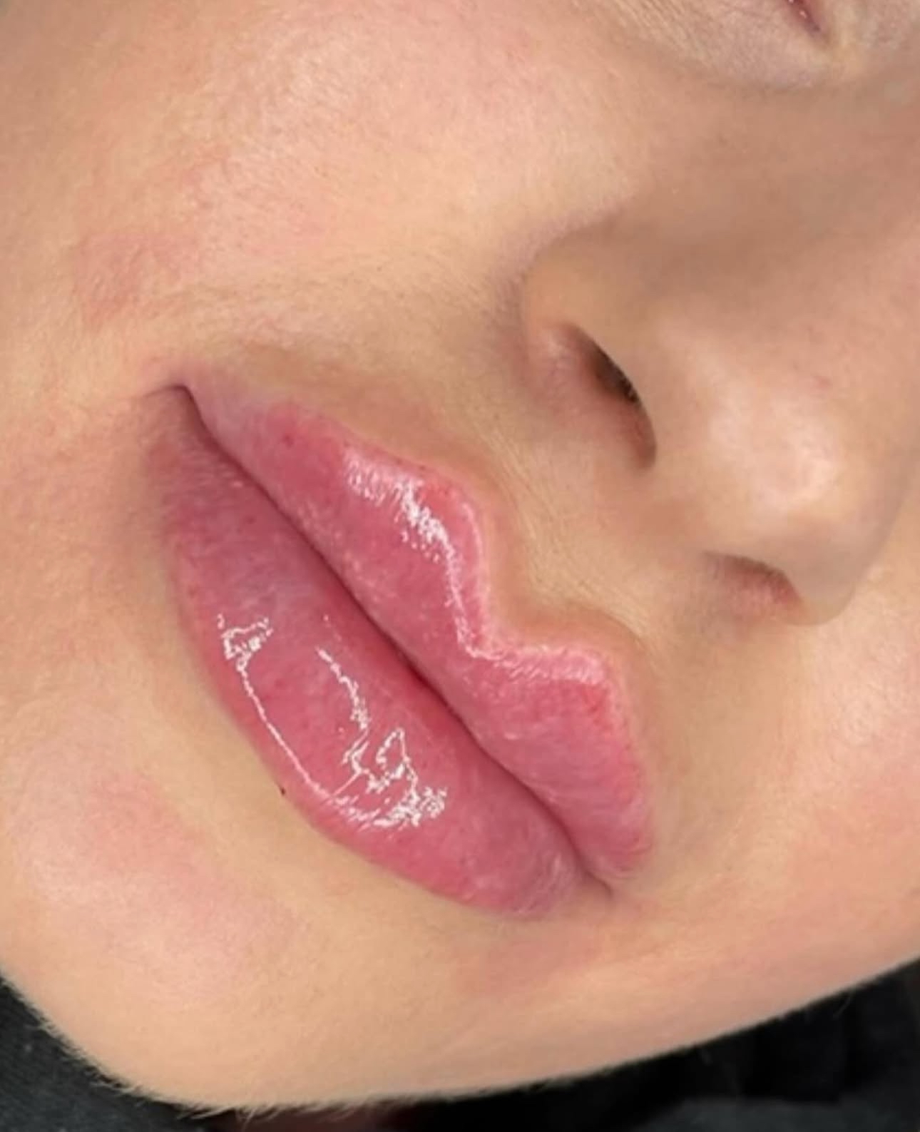 Anti-Wrinkle Injections